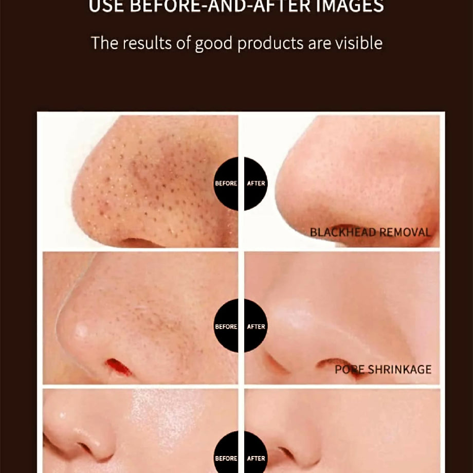 Kinyea nose blackheads whitehead removal shrink pores patch mask
